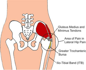 Lateral hip pain can be caused by tight or