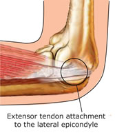 Tennis Elbow is an injury of the extensor tendon attachment on the outer side of the elbow. Golfer's Elbow occurs on the inner side of the elbow.