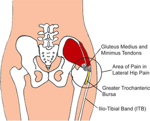 Lateral hip pain can be caused by tight or 