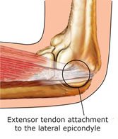 Tennis elbow occurs where the extensor tendons attach to the bone.
