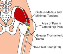 Lateral hip pain is often due to muscle tightness or over-activity.