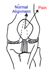 Knee cap pain is often caused by muscle imbalance.