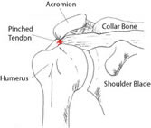 Shoulder rotator cuff injuries are due to pinching of the tendon between the bones around the shoulder joint.